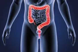 Bowel Cancer Symptoms: What Causes Bowel Cancer?