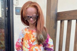 What has happened to Adalia Rose? What is Adalia Rose’s life expectancy?