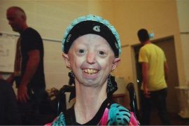 Is Hayley with progeria still alive? Who is the oldest person with progeria?