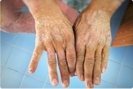 Scleroderma Signs And Symptoms