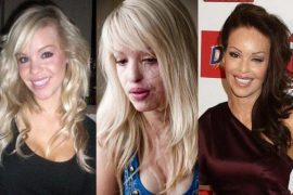 Katie Piper Before Acid: What acid did Katie Piper use?