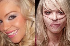 What Happened To Katie Piper?