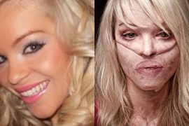Katie Piper Before Burns, Net Worth, Book, Wedding, No Makeup, Age