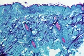 Monkeypox virus outbreak Australia: Any case recorded in Australia yet?