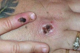 Where is Monkeypox in the US?