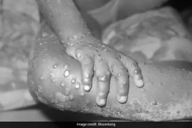 What does Monkeypox do to humans? Who is most affected by monkeypox?