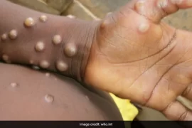 Is there monkeypox in South Africa?
