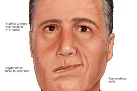 Ramsay Hunt Syndrome after covid vaccine: Can you get facial paralysis from the COVID-19 vaccine?