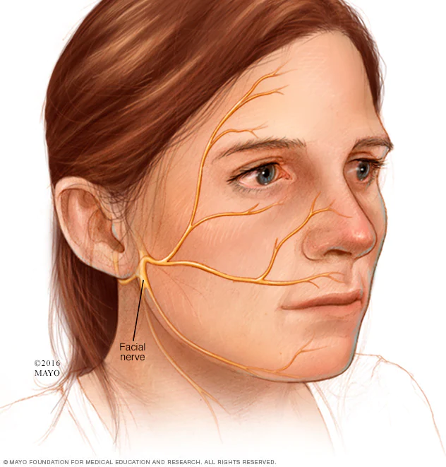 Ramsay Hunt Syndrome