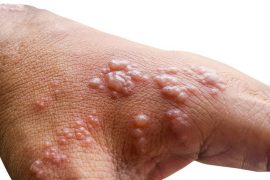 Monkeypox affects who?