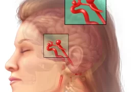 What causes brain aneurysm? Can you survive a brain aneurysm? How can you prevent a brain aneurysm?