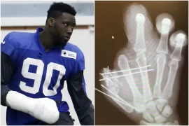 What happened to Pierre Pauls hand? Is Pierre-Paul missing a finger?