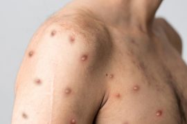 Where did the 2003 outbreak of monkeypox take place?