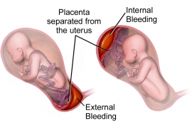 Can a Baby Survive After Placental Abruption?