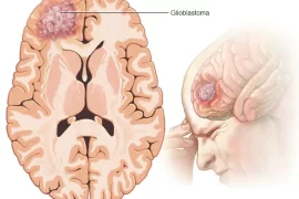 Is Glioblastoma Hereditary?