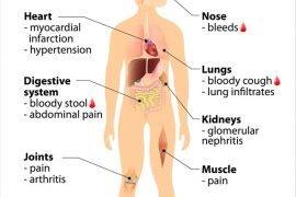 Is Vasculitis Fatal?