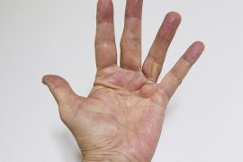 What happens if you don’t treat Dupuytren’s contracture? What happens if Dupuytren’s contracture is left untreated?