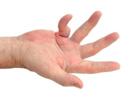 What is the best natural treatment for Dupuytren’s contracture?