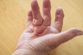 Who is prone to Dupuytren’s contracture? Who is at risk for Dupuytren’s contracture?