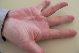 What triggers Dupuytren’s contracture?