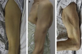 Does stiff person syndrome cause fatigue? Is stiff person syndrome psychological?