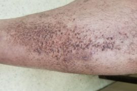 How long is treatment for amyloidosis? Does chemo cure amyloidosis?
