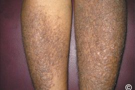 What infection causes amyloidosis? What organs are affected by amyloidosis? Can amyloidosis be cured?