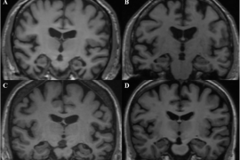 Can stress cause frontotemporal dementia? How do you delay frontotemporal dementia?