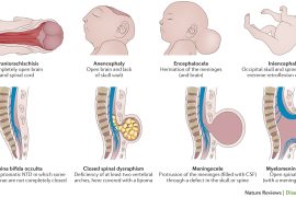 What is another name for spina bifida? Can a child with spina bifida be normal?