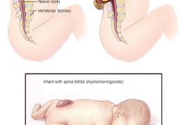 How do I know if my baby has spina bifida? Can you breastfeed a baby with spina bifida? Can babies with spina bifida move their legs?