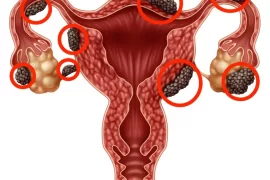 Do you ovulate with endometriosis? Will removing uterus stop endometriosis?