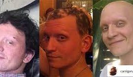 What happened to Anthony Carrigan? When did Anthony Carrigan lose all his hair?