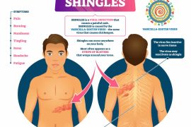 Is Shingles Dangerous? Can Shingles Kill You?