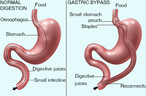 What are 6 complications related to bariatric surgery? What is the biggest complication that can happen to a bariatric patient’s wound?