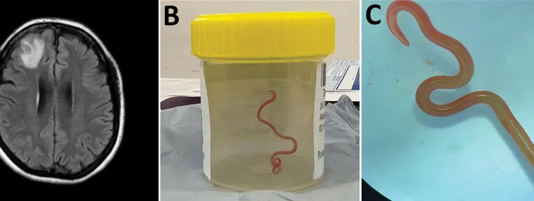 What are the symptoms of worms in the brain? How do you know if you have brain infection?