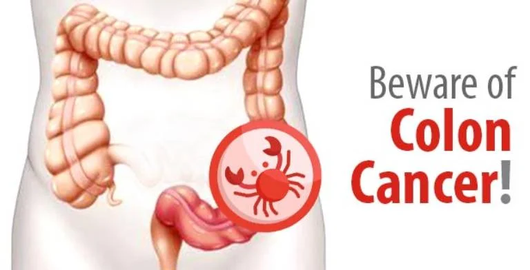 What are the 1st signs of colon cancer? Can a CT scan detect colon cancer?