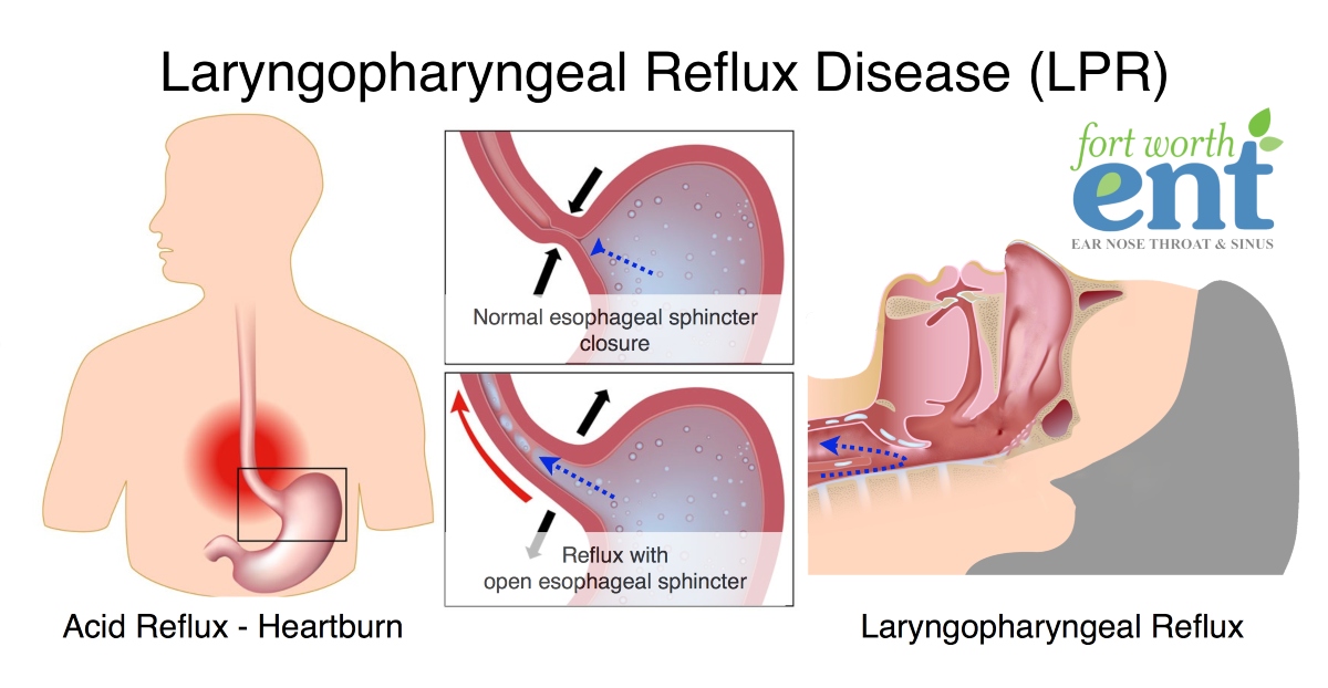 Can laryngopharyngeal reflux be cured? What is the best treatment for laryngopharyngeal reflux?