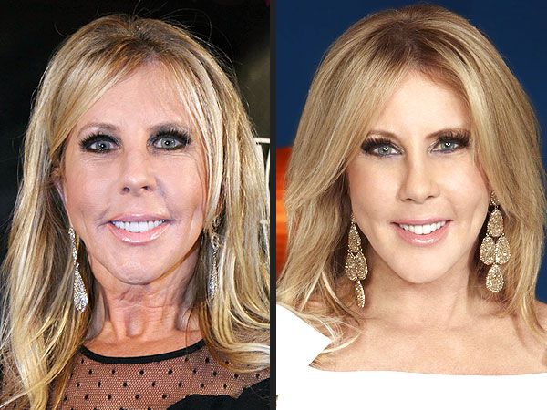 What surgery has Vicki Gunvalson had?