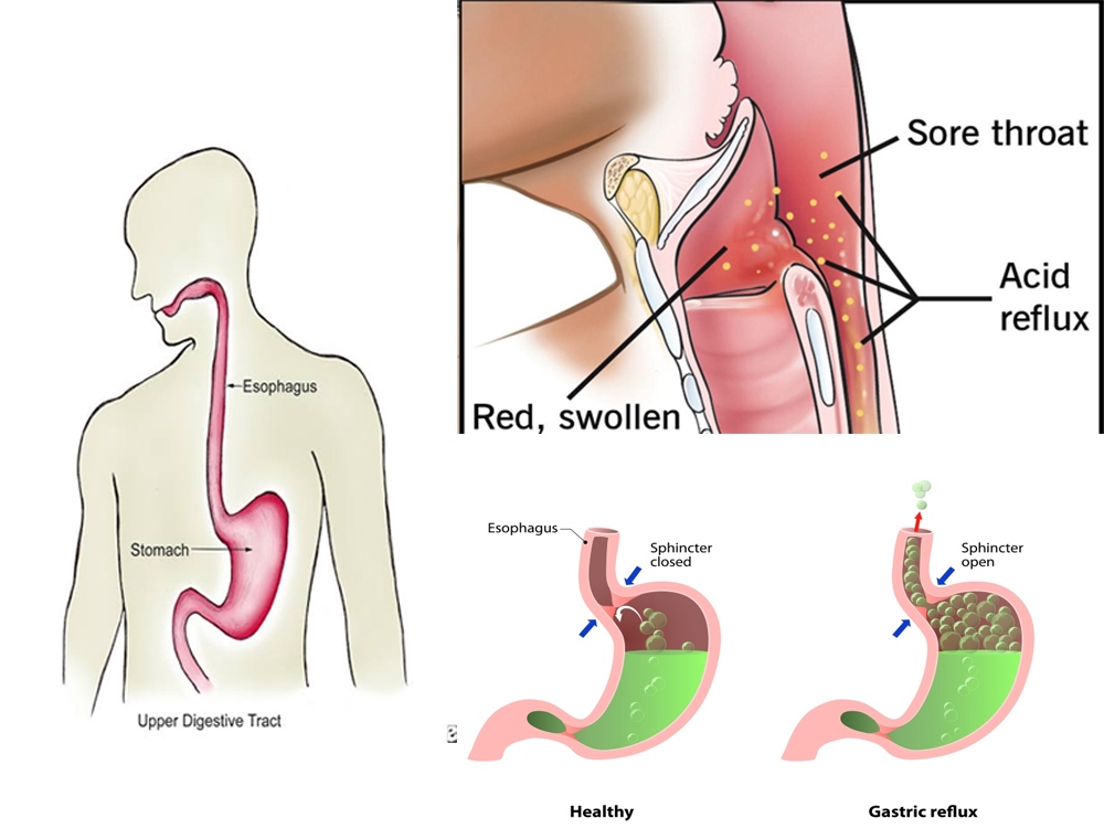 What is laryngopharyngeal reflux also known as? Can LPR be cured permanently?