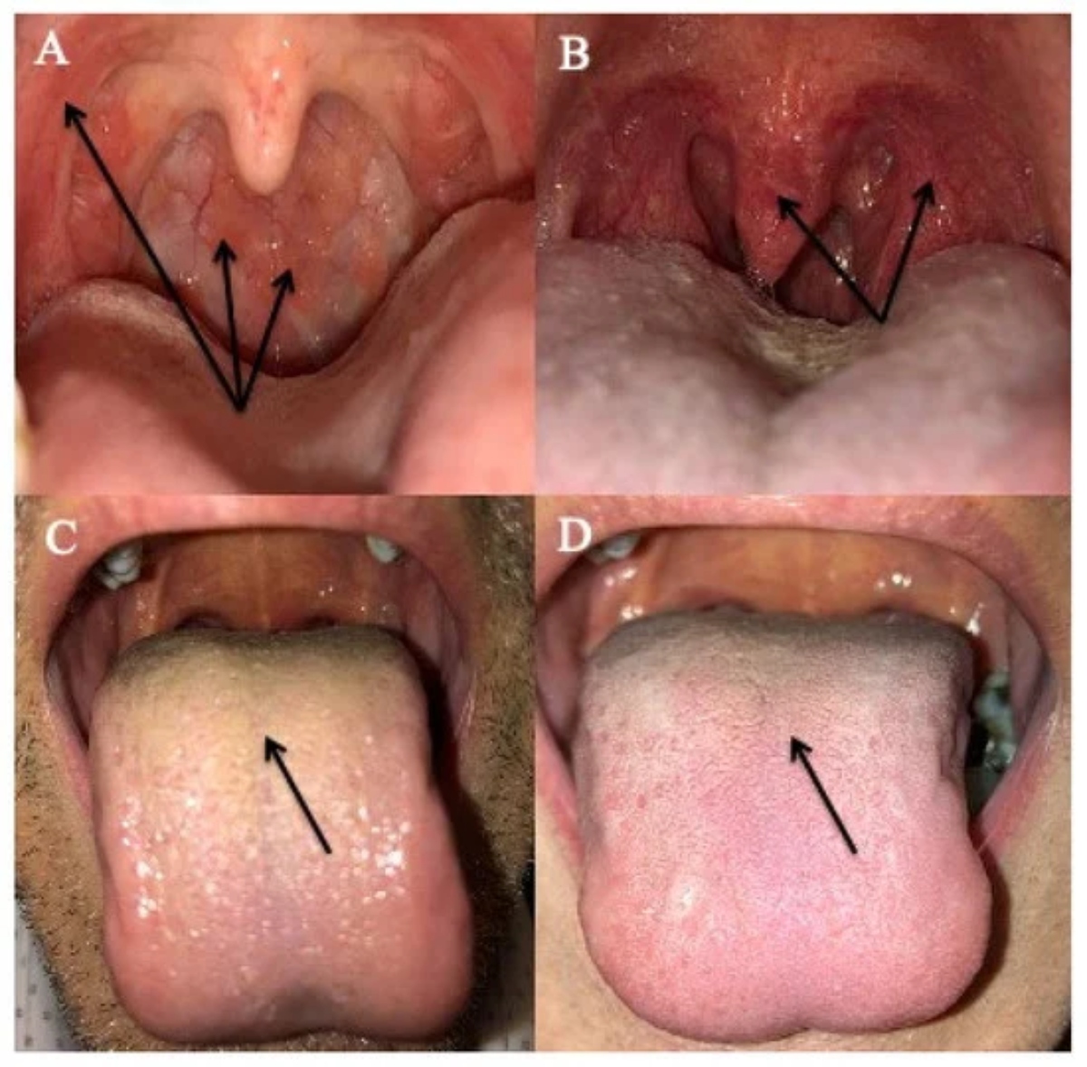 What kind of doctor treats LPR? What happens if LPR is left untreated?