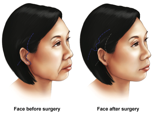 Which nerve must be avoided during a rhytidectomy? What nerve is injured in rhytidectomy?