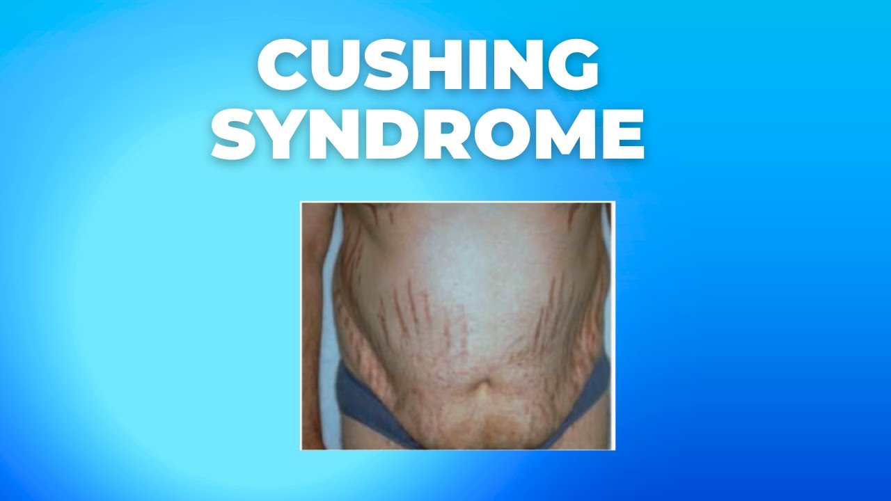 What is the difference between Cushing’s disease and PCOS?