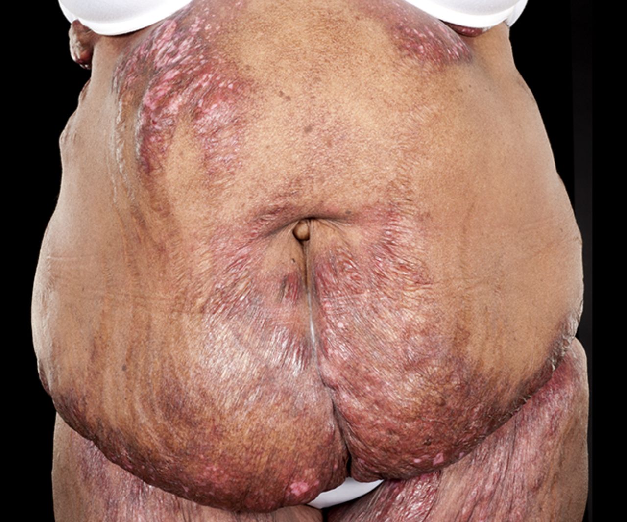 What organs are affected by Cushing’s syndrome?