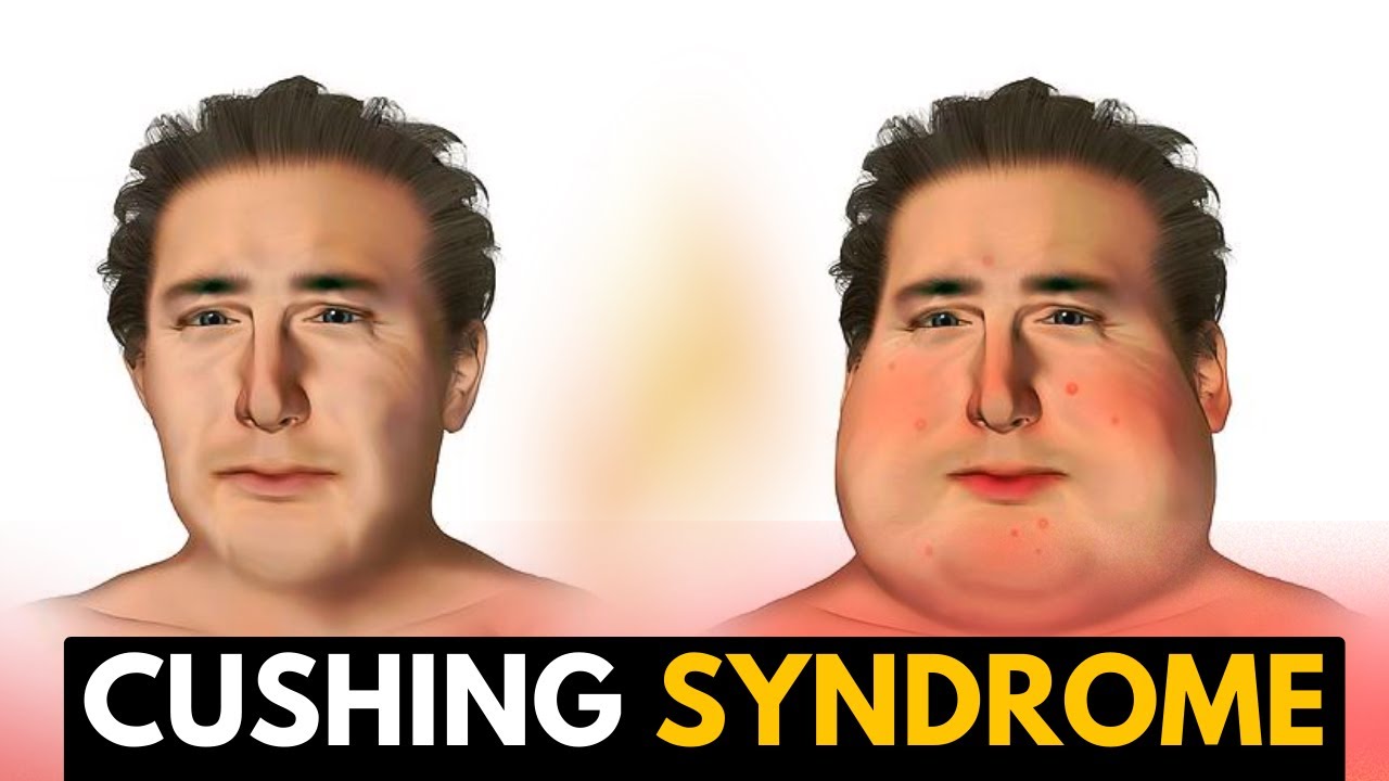 Which is a common clinical feature of Cushing syndrome?