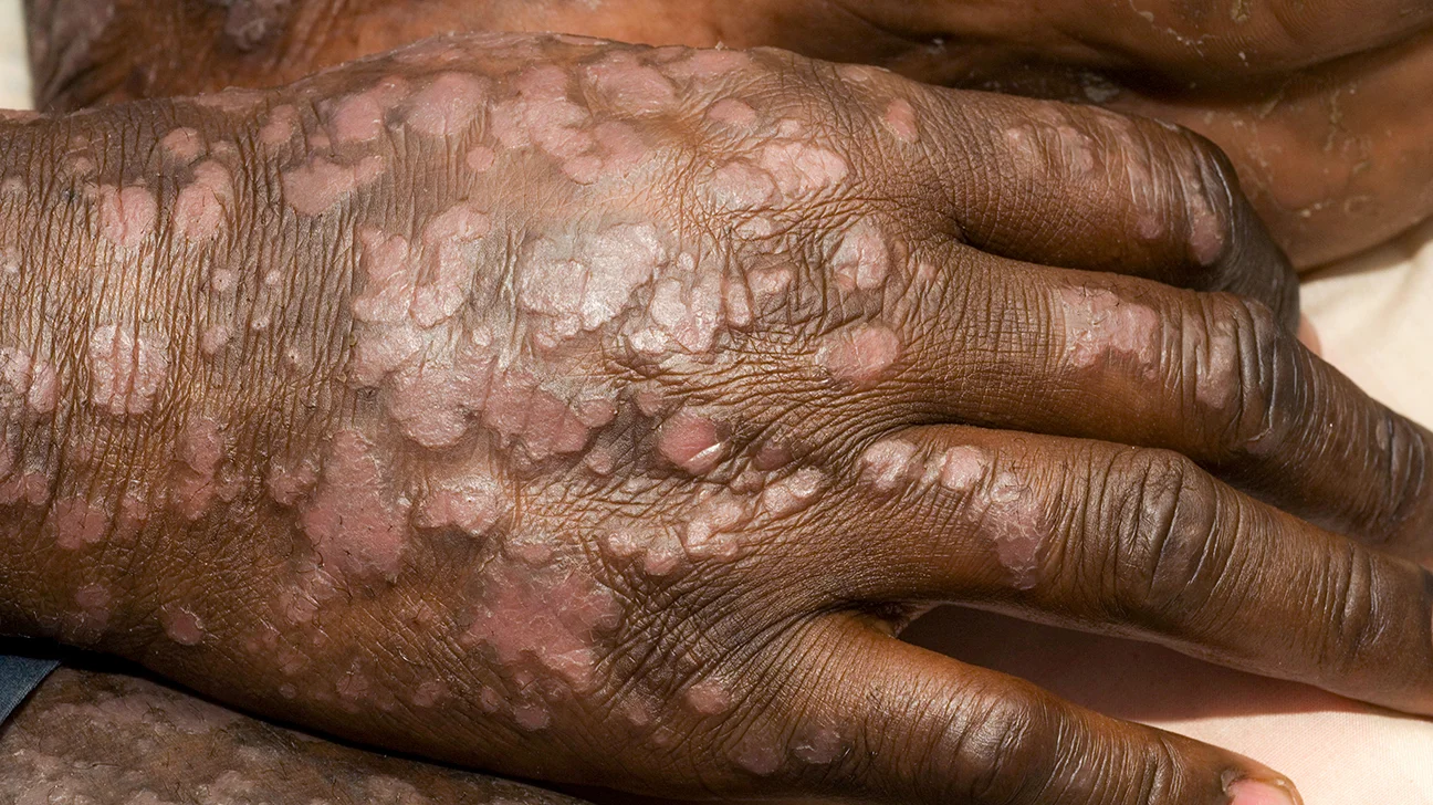 Can psoriasis be cured? What does psoriasis pain feel like?