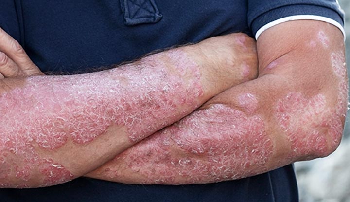 Psoriasis treatment, pictures, causes, contagious, types