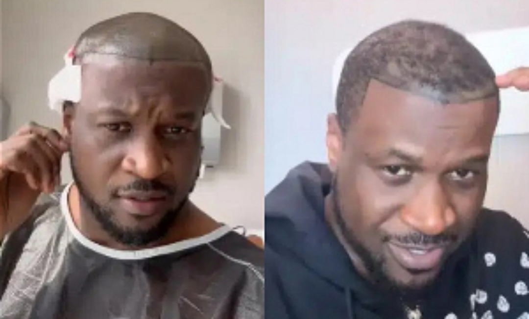 Peter Okoye of P-Square Fame Successfully Undergoes Hair Implant Procedure