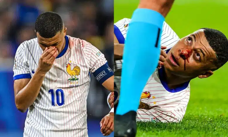 Euro 2024: Mbappe to Wear Protective Mask After Nose Fracture, Confirms French FA