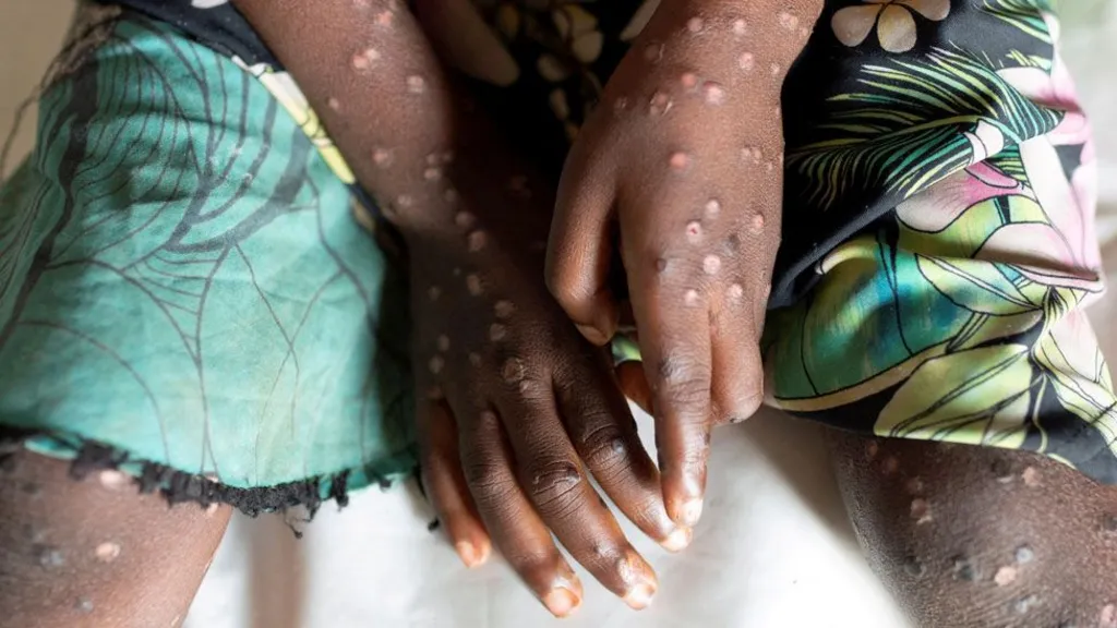 Mpox declared public health emergency By Africa CDC